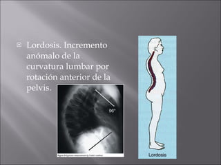 Lordosis. Incremento anómalo de la curvatura lumbar por rotación anterior de la pelvis. 