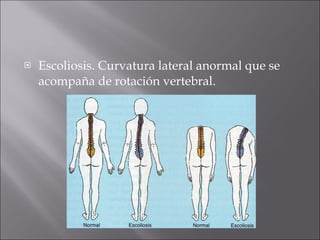 Escoliosis. Curvatura lateral anormal que se acompaña de rotación vertebral. 