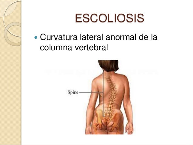 El tratamiento operativo de la escoliosis el coste