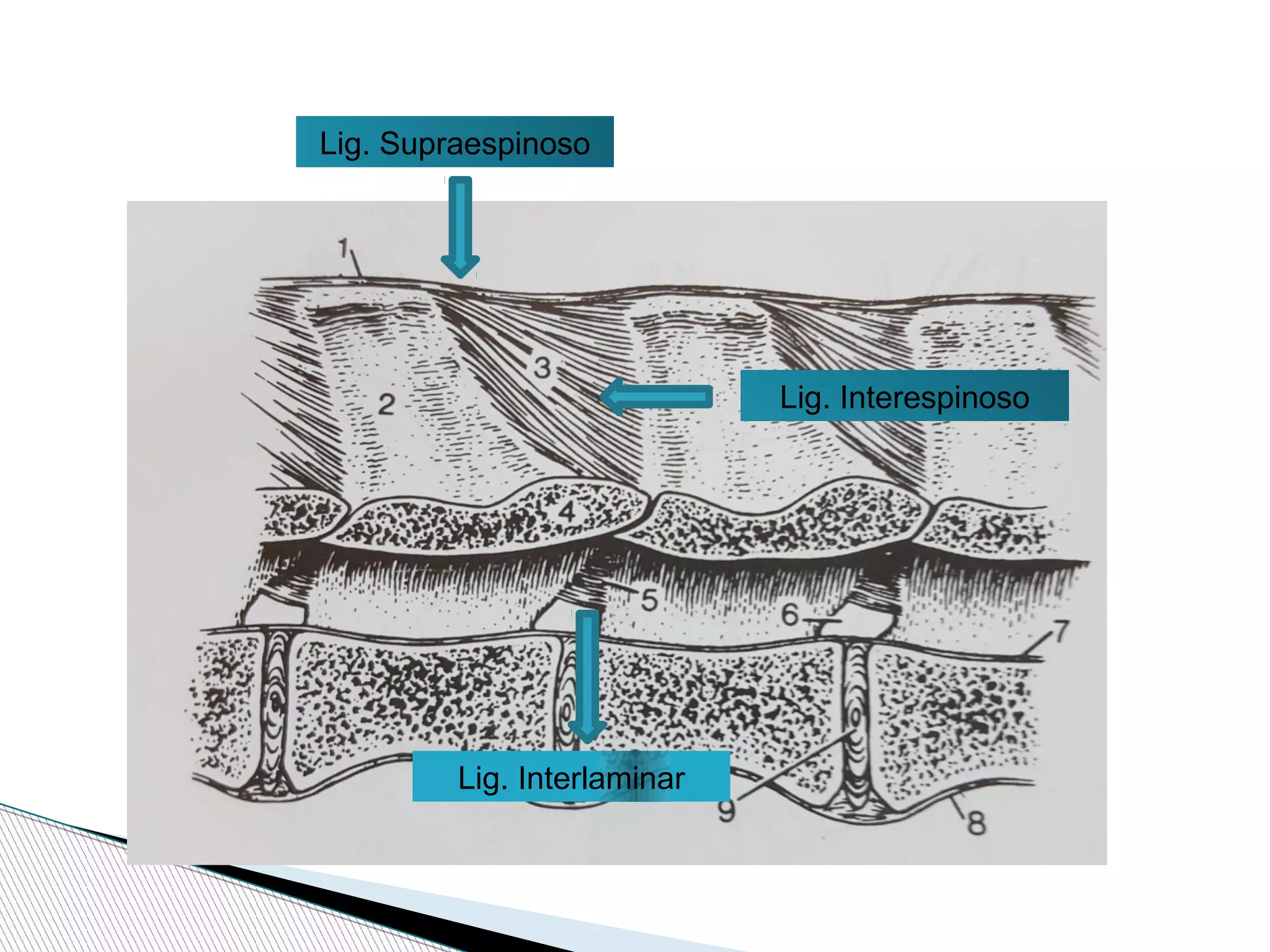 Lig. Interlaminar
Lig. Interespinoso
Lig. Supraespinoso
 