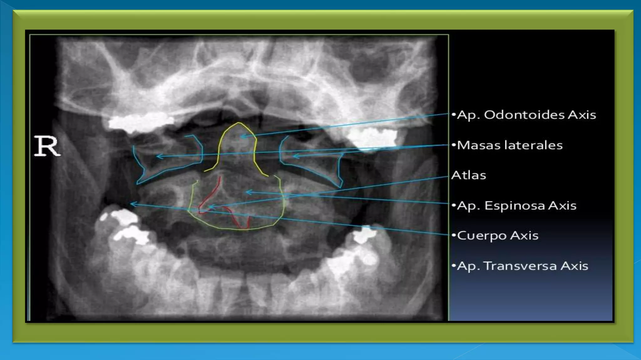 Columna Vertebral RX | PPTX