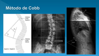 Columna Vertebral RX | PPTX