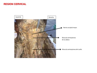 REGION CERVICAL
Musculo semiespinoso
de la cabeza
Nervio occipital mayor
Musculo semiespinoso del cuello
DerechaIzquierda
 
