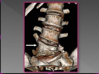 Vertebral Pathologies Comprehensive Overview of Vertebral Anatomy, Pathologies, and Imaging ...