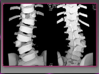 Vertebral Pathologies Comprehensive Overview of Vertebral Anatomy, Pathologies, and Imaging ...