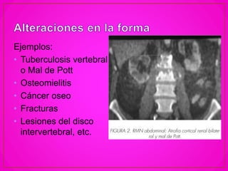 Ejemplos:
• Tuberculosis vertebral
o Mal de Pott
• Osteomielitis
• Cáncer oseo
• Fracturas
• Lesiones del disco
intervertebral, etc.
 