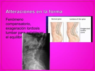 Fenómeno
compensatorio,
exageración lordosis
lumbar para establecer
el equilibrio.
 