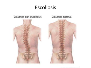 Escoliosis
 