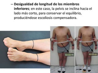 – Desigualdad de longitud de los miembros
inferiores; en este caso, la pelvis se inclina hacia el
lado más corto, para conservar el equilibrio,
produciéndose escoliosis compensadora.
 