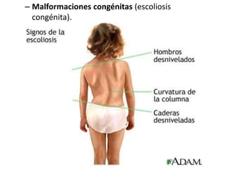 – Malformaciones congénitas (escoliosis
congénita).
 