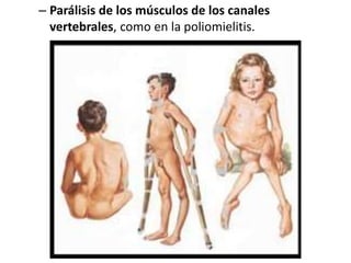 – Parálisis de los músculos de los canales
vertebrales, como en la poliomielitis.
 