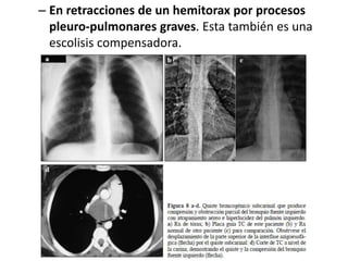 – En retracciones de un hemitorax por procesos
pleuro-pulmonares graves. Esta también es una
escolisis compensadora.
 