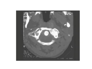 Columna vertebral generalidades