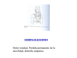 Dolor residual, Perdida permanente de la
movilidad, distrofia simpatica.
C O M P L I C A C I O N E S
 