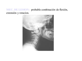 MEC. DE LESION: probable combinación de flexión,
extensión y rotacion.
 