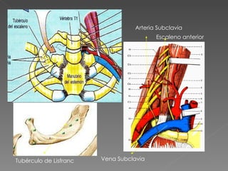 Tubérculo de Lisfranc Arteria Subclavia Escaleno anterior Vena Subclavia 