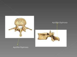 Apófisis Espinosa Apófisis Espinosa 