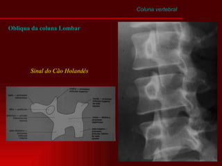 Coluna vertebral Obliqua da coluna Lombar Sinal do Cão Holandês 