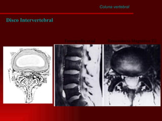 Coluna vertebral Disco Intervertebral Tomografia axial Ressonância Magnética T2 