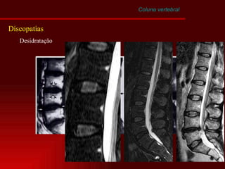 Coluna vertebral Discopatias Desidratação 