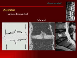 Coluna vertebral Discopatias Herniação Intravertebral  Schmorl 