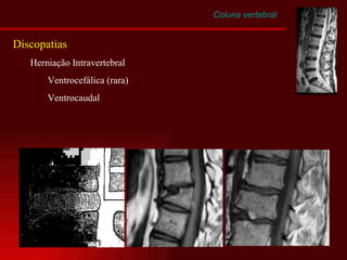 Coluna vertebral Discopatias Herniação Intravertebral Ventrocefálica (rara) Ventrocaudal 