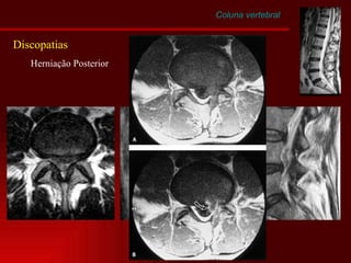 Coluna vertebral Discopatias Herniação Posterior 