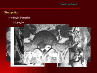 Coluna vertebral Discopatias Herniação Posterior Migração 