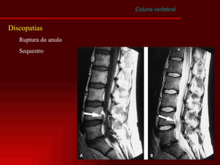 Coluna vertebral Discopatias Ruptura do anulo Sequestro 