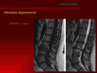 Coluna vertebral Alterações degenerativas MODIC I = agua 