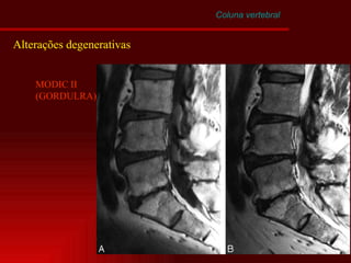 Coluna vertebral Alterações degenerativas MODIC II (GORDULRA) 