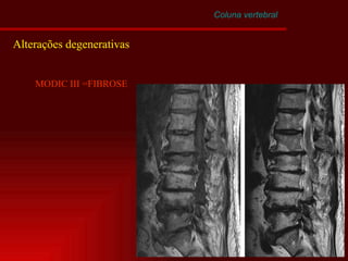 Coluna vertebral Alterações degenerativas MODIC III =FIBROSE 