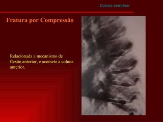 Coluna vertebral Fratura por Compressão Relacionada a mecanismo de flexão anterior, e acomete a coluna anterior. 
