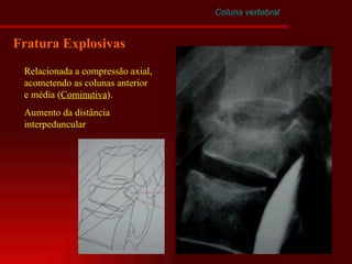 Coluna vertebral Fratura Explosivas Relacionada a compressão axial, acometendo as colunas anterior e média ( Cominutiva ). Aumento da distância interpeduncular 
