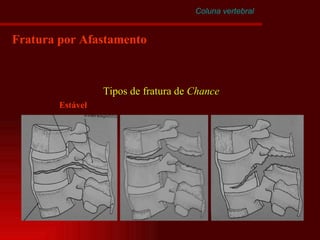 Coluna vertebral Fratura por Afastamento Tipos de fratura de  Chance Estável 