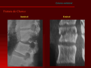 Coluna vertebral Fratura de  Chance Instável Estável 