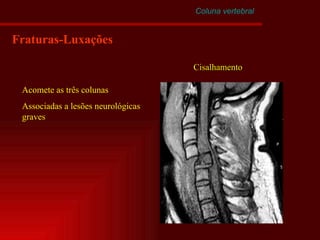 Coluna vertebral Fraturas-Luxações Cisalhamento Acomete as três colunas Associadas a lesões neurológicas graves 