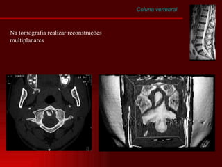 Coluna vertebral Na tomografia realizar reconstruções multiplanares 