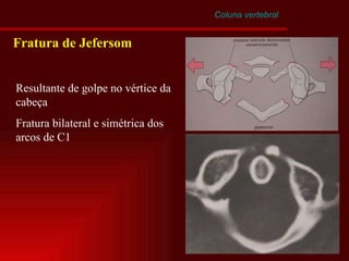 Coluna vertebral Fratura de Jefersom Resultante de golpe no vértice da cabeça Fratura bilateral e simétrica dos arcos de C1 