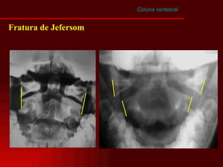 Coluna vertebral Fratura de Jefersom 