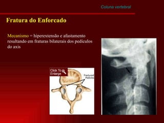 Coluna vertebral Fratura do Enforcado Mecanismo  = hiperextensão e afastamento resultando em fraturas bilaterais dos pedículos do axis 