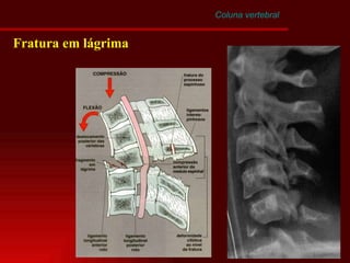 Coluna vertebral Fratura em lágrima 