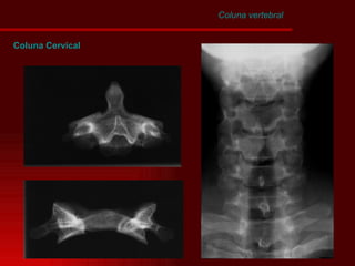 Coluna Cervical Coluna vertebral 