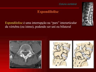 Coluna vertebral Espondilolise Espondilolise  é uma interrupção na “pars” interarticular da vértebra (ou istmo), podendo ser uni ou bilateral 