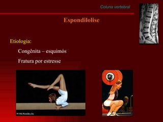 Espondilolise Coluna vertebral Etiologia: Congênita – esquimós Fratura por estresse 