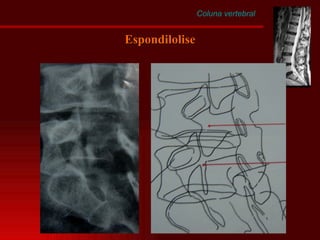 Coluna vertebral Espondilolise 