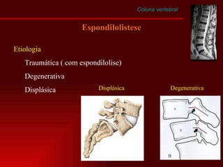 Coluna vertebral Espondilolistese Etiologia Traumática ( com espondilolise) Degenerativa Displásica Displásica Degenerativa 