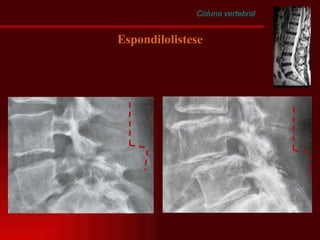Coluna vertebral Espondilolistese 