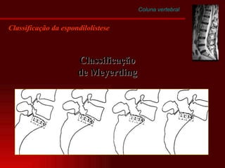Coluna vertebral Classificação da espondilolistese Classificação de Meyerding 