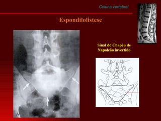 Coluna vertebral Espondilolistese Sinal do Chapéu de Napoleão invertido 